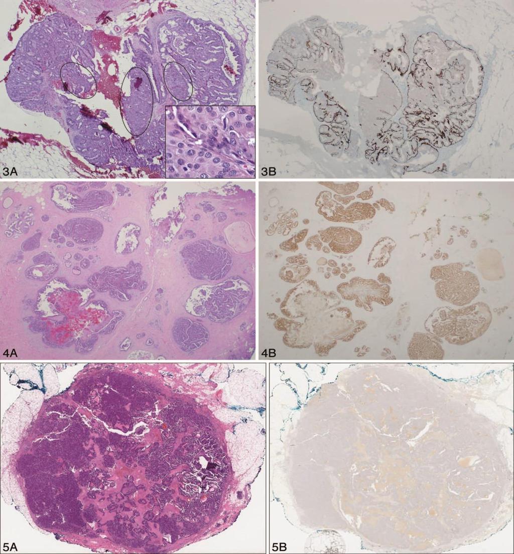 Figure 3. A, Intraductal papilloma with ductal carcinoma in situ (DCIS) with solid growth (circles), moderate cytologic atypia, and prominent cell borders (inset).