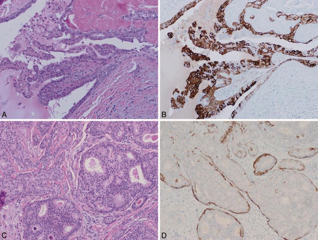 Case with both benign intraductal papilloma and usual ductal hyperplasia (UDH) (A), with corresponding cytokeratin 5 / 6 immunohistochemical (IHC)