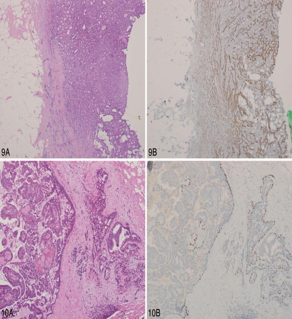 Figure 9. A, Intraductal papilloma with pseudoinfiltrative, benignappearing glands within the fibrous capsule and associated fat necrosis/biopsy site change.