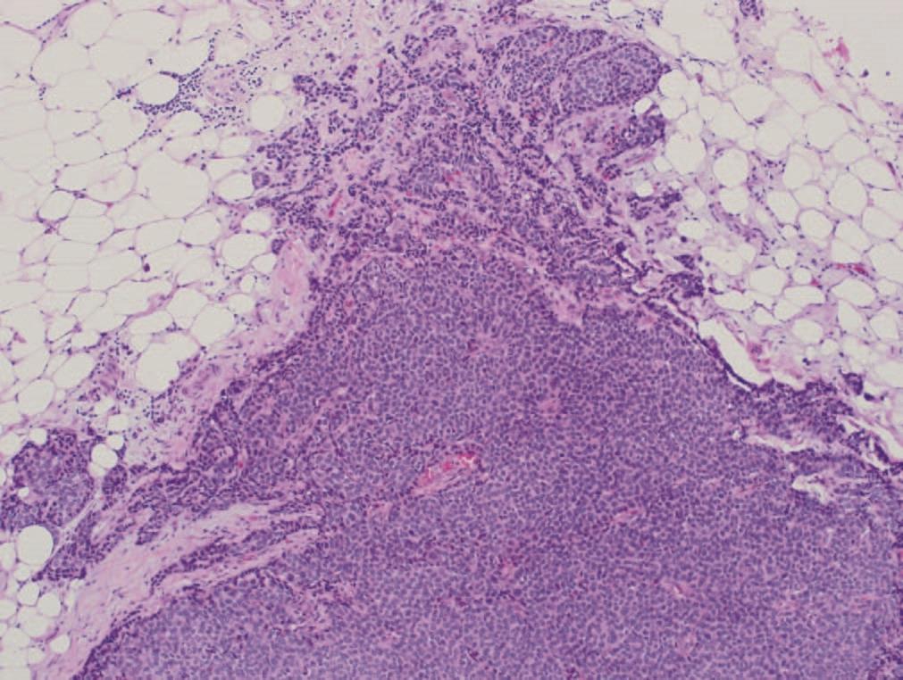 Frank, invasive ductal carcinoma, arising in association with an encapsulated papillary