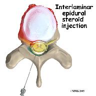lower lumbar spine there are only spinal nerves running within the spinal canal. The epidural space is normally filled with fat and blood vessels.