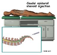 The caudal injection is performed at the very lower end of the spine through a small opening in the bones of the sacrum.