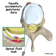 Probably the most common complication of an ESI is a wet tap. This occurs when the needle penetrates the spinal sac and enters the spinal fluid.