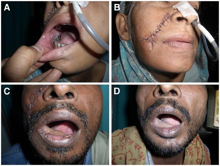 Singh et al. World Journal of Surgical Oncology 2012, 10:227 Page 3 of 5 Figure 2 Use of nasolabial tunnel flap. (A) Intraoral view, showing flap inserted on lower alveolus.