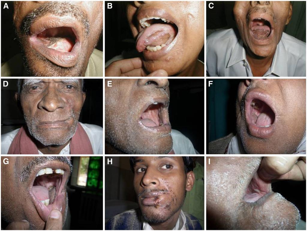 Singh et al. World Journal of Surgical Oncology 2012, 10:227 Page 4 of 5 Figure 3 Late postoperative clinical photographs during follow-up, showing use of nasolabial flap. (A) Dorsum tongue.