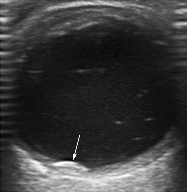 b Colour Doppler US image shows a dome-shaped hypoechoic posterior mass with a smooth surface and choroidal excavation underneath (arrow), as well as internal blood flow.