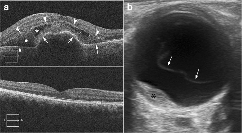 362 Insights Imaging (2016) 7:351 364 Fig. 23 Neovascular age-related macular degeneration.