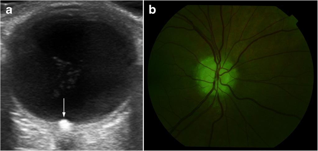 neurosensory retinal detachment (arrowheads). Note also the subretinal haemorrhage (white circle) and subretinal fluid (white asterisk). Bottom image: nonpathologic OCT in another patient.