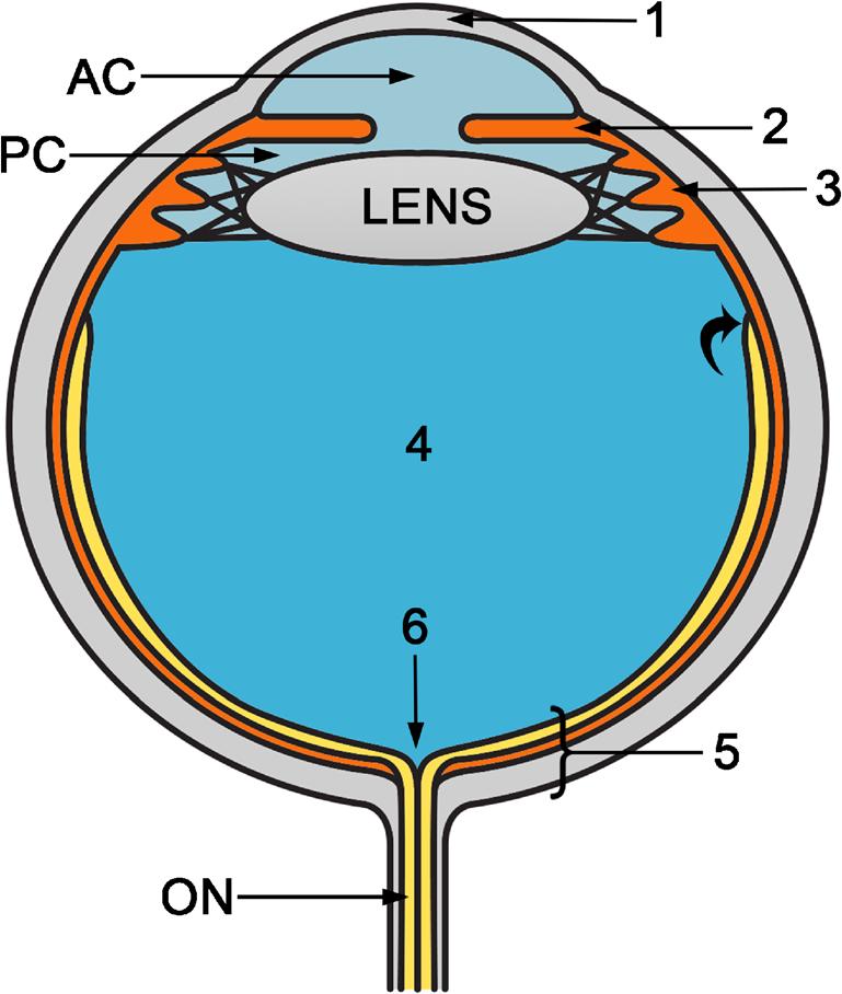352 Insights Imaging (2016) 7:351 364 Table 1 Summary of Ocular Pathologic Conditions Based on the Affected Structure Ocular globe size and shape Posterior staphyloma Phthisis bulbi Lens Cataracts