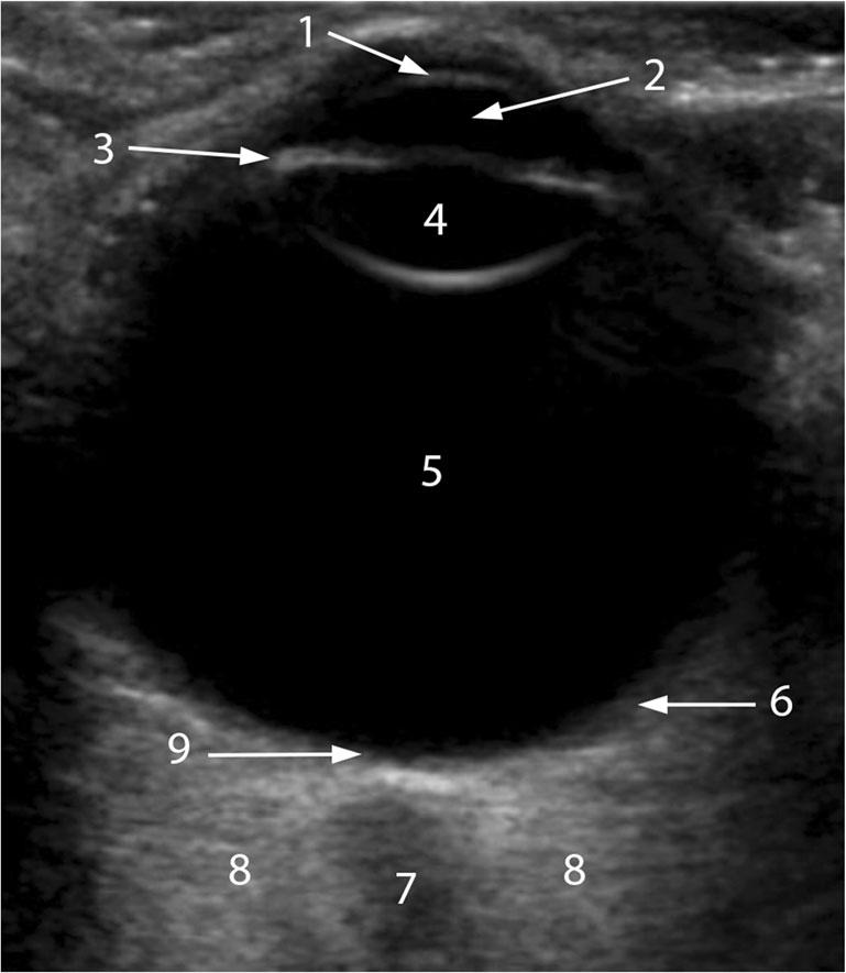 Insights Imaging (2016) 7:351 364 Fig. 2 Sonographic appearance of the structures of the normal eye.