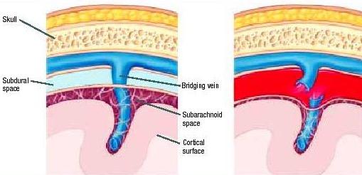 arachnoid subdural hemorrhage results