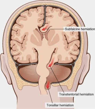 Meningeal Compartments Introduction of any mass into the cranial cavity causes increased