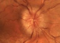 Papilledema can be confirmed with a fundoscopic exam.