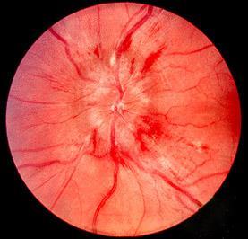 Papilledema A swollen optic disc caused by increased intracranial pressure Can be