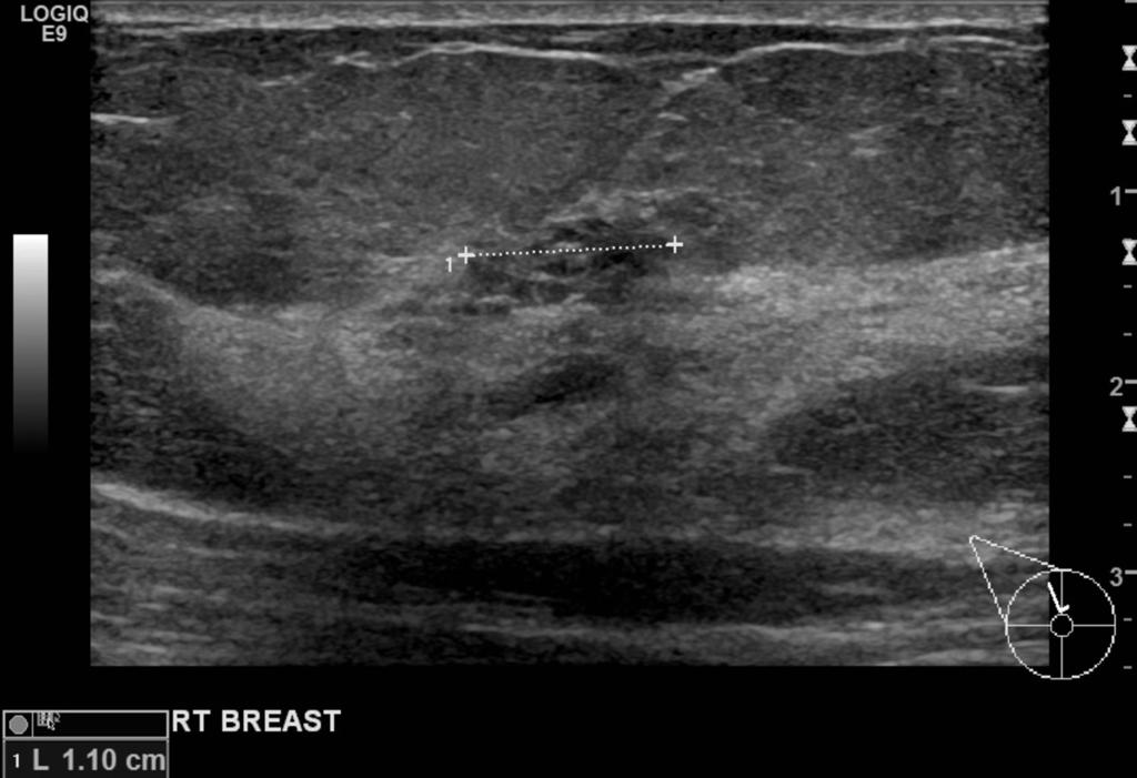 Fig. 5: Case 2: Pseudomicrocystic appearance seen on ultrasound, correlating to the mammographically detected
