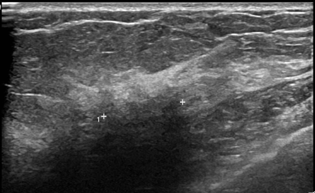 Fig. 9: Case 4: A subtle area of architectural distortion picked up on screening mammography(arrow). This was further evaluated with ultrasound. Fig.