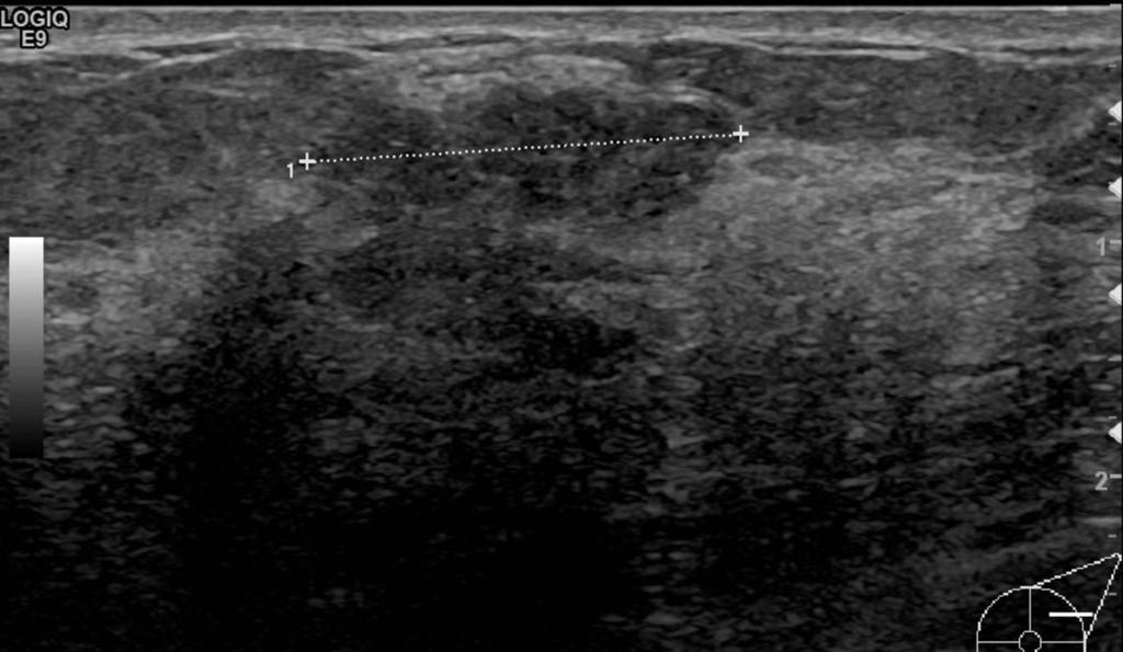 Fig. 11: Case 5: Screening mammogram of a 69y old woman showing a