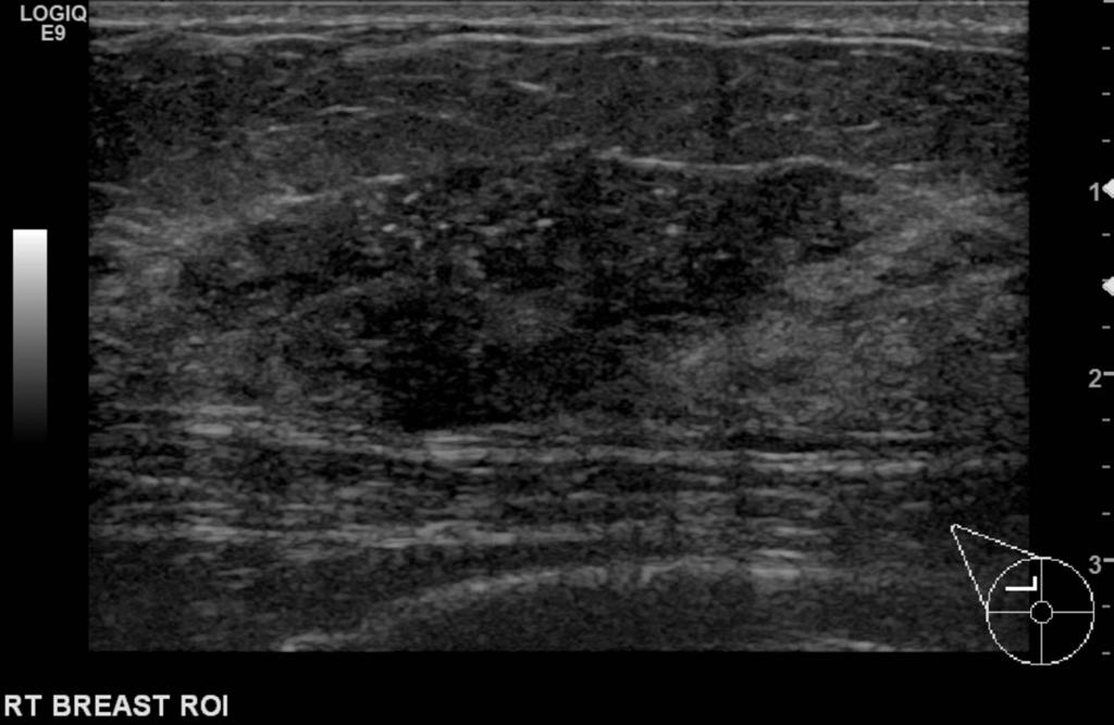 Fig. 1: Case 1 Widespread calcifications detected on screening mammogram(arrows). Fig.