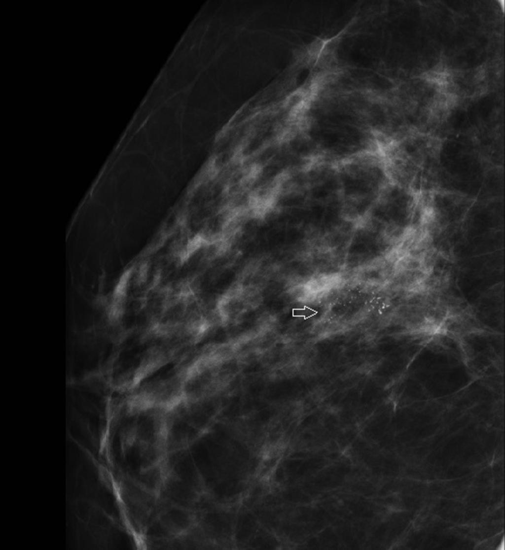 Fig. 4: Case 2: Screening mammogram of a 55 y old woman shows a localized cluster of