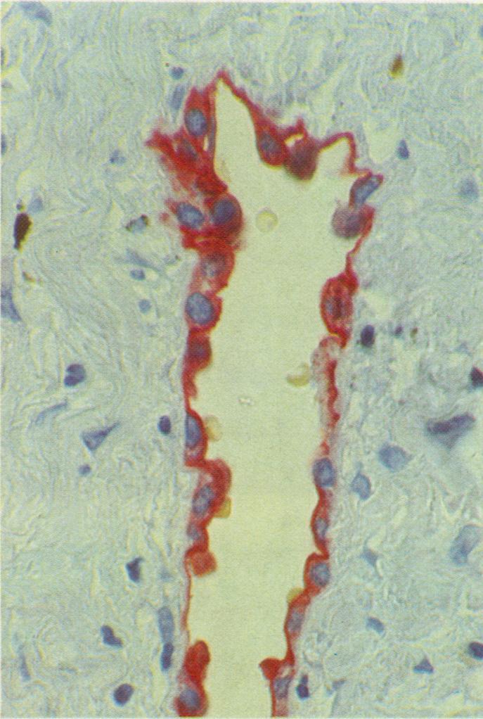 exfoliated cells (bottom ofpicture). Flatter overlying mesothelium (closed arrows) is more weakly stained.