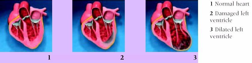 Ventricular Reconstruction Popularized by DOR Initially used for LV aneurysm