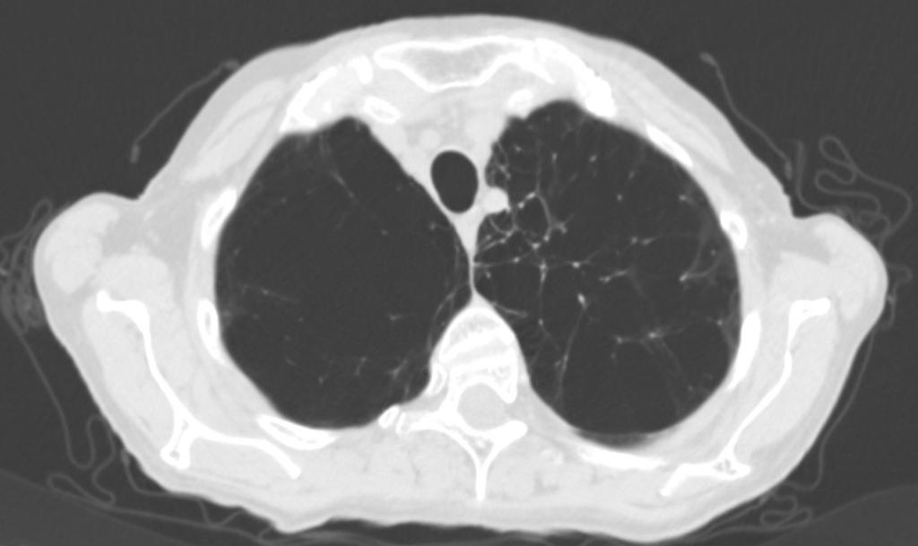 Fig. 3: Axial CT section of a patient with severe