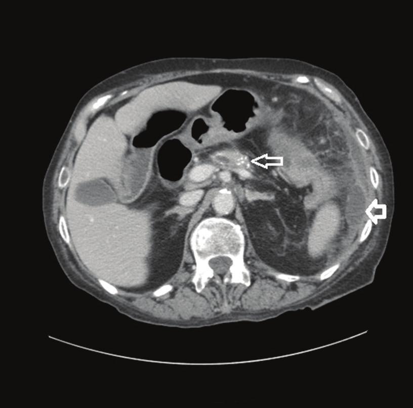 2 Case Reports in Gastrointestinal Medicine Figure 1: CT abdomen/pelvis done at time of admission to outside hospital showing colonic thickening at the splenic flexure.