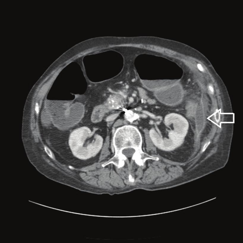 Figure 2: CT abdomen/pelvis done at outside hospital at time of admission: Fat arrow indicates fluid collection near the pancreatic tail and splenic flexure 3.5 cm.
