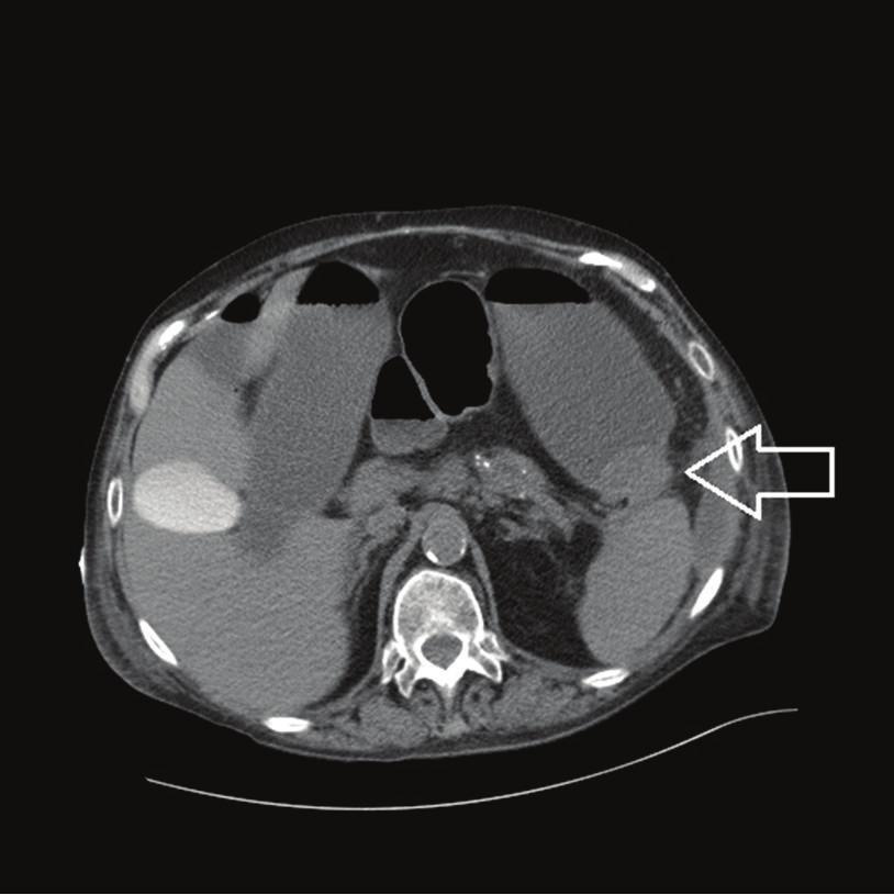 Figure 3: CT abdomen/pelvis done at outside hospital at time of admission showing fluid collection around the pancreatic tail and splenic flexure 4.7 cm.