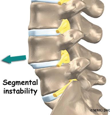 Extra pressure on the facet joints, such as that from a collapsing disc, can speed the degeneration in the facet joints.