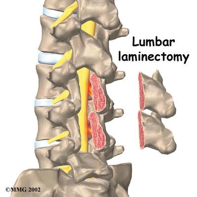 Surgery Only rarely is lumbar spine surgery scheduled right away.