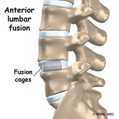 Posterior Lumbar Interbody Fusion: Finally, surgeons may combine the two methods of anterior fusion and posterior fusion.