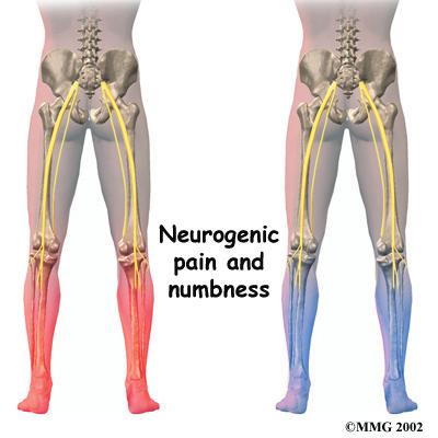 they pass through the neural foramina. This pressure around the irritated nerve roots can cause pain, numbness, and weakness in the low back, buttocks, and lower limbs and feet.