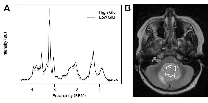 Glutamate as a biomarker of poor prognosis in medulloblastoma Subtle changes in vivo need high