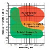 Criteria for cochlear implantation http://www.bcig.org.