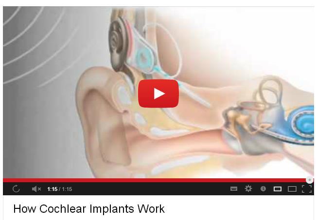 How do cochlear implants work?