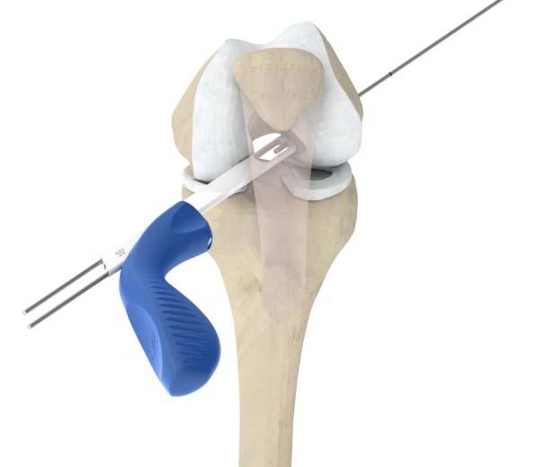 Re-Insert the femoral aimer by coupling the tip with the proximal portion of the central k-wire.