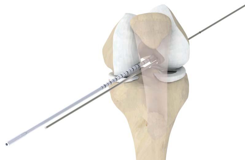 Remove the Femoral Aimer and over drill the lateral k- wires up to 30 mm depth.