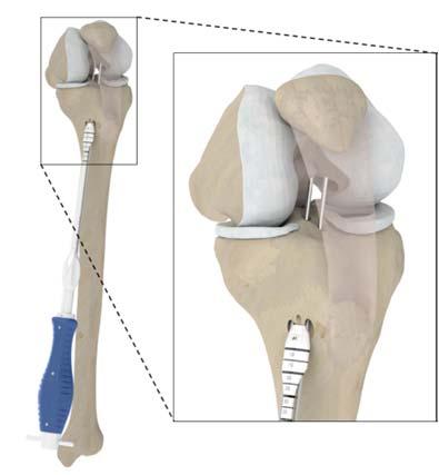 4.2. Tibial Dilation Insert the two guidewires in the tibial dilator. Insert the dilator.
