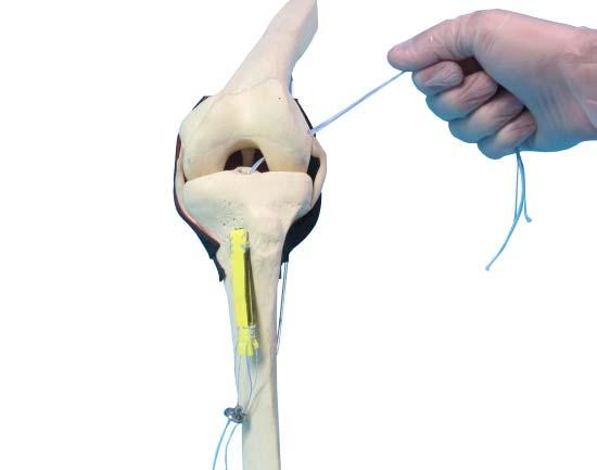 5. Graft Insertion The Femoral button is represented with the pre-set button suture length and specifically: (1) Femoral button hole for the pulling suture (2) Femoral button hole for the tilting