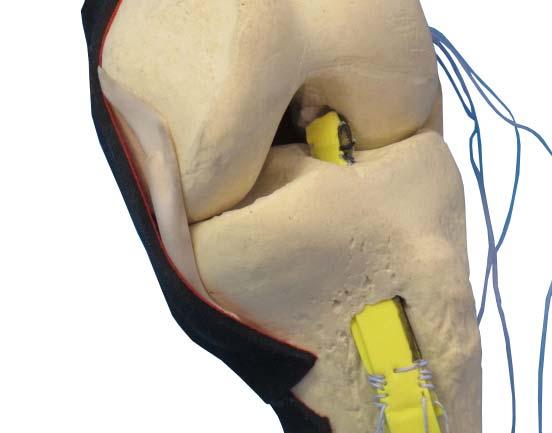 To better control the twisting of the graft in the joint during the insertion, it can be helpful to mark the posteromedial edge of the ligament with a marker.