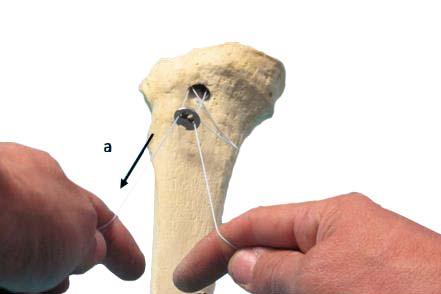 In order to mimic the rotation of the cruciate ligament, the posterior graft sutures (b) are pulled in the anterior direction from behind the anterior pair of sutures (a) by using a probe in order to