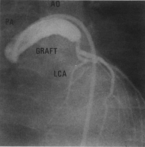 CASE REPORT: Correction of Anomalous LCA FIG. 2. Selective injection into vein shows patent graft with antegradeflow into the left coronary artery (LCA) system. (A0 = aorta; PA = pulmonary artery.