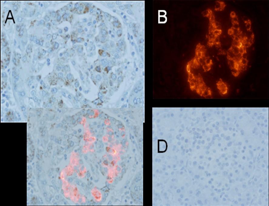 Supplementary Figure 2. Immunohistochemical staining of the pancreas obtained from fulminant type 1 diabetes for enterovirus capsid protein (VP1)(A) and insulin (B).