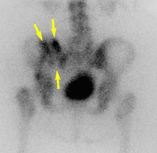 Medical History: December 2009 A radionuclide bone scan image of the posterior pelvis