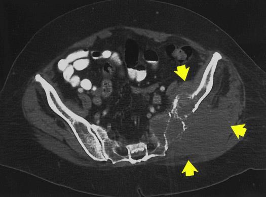 A CT image showed a large, lytic bone metastasis of the left pelvis with invasion of the left