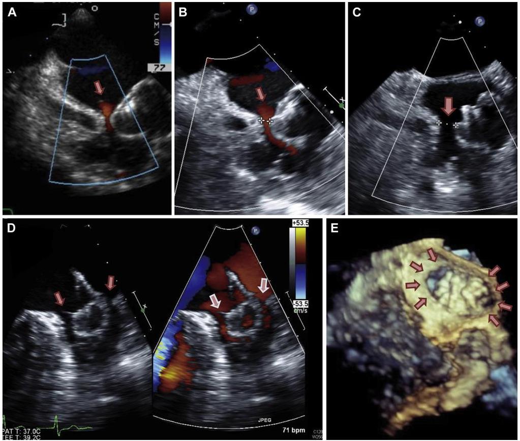 A case with progressive increase in peridevice leakage after the Implantation of the Watchman