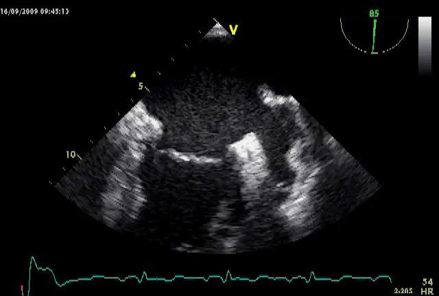 LAA and AF The left atrial appendage (LAA) is the major location of thrombi in patients with AF The 4