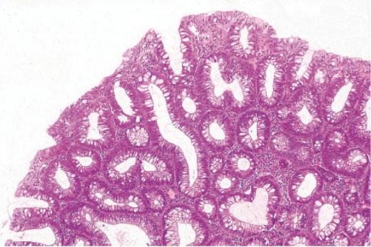 Further accumulation of patients will be needed. DEVELOPMENT AND PROGRESSION OF COLON ADENOMAS THERE ARE SOME studies 19 24 on the natural history of colorectal polyps <10 mm in diameter.