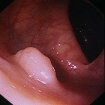 Although all colorectal adenomas have the ability to become cancers, only a few lesions develop cancer, and most adenomas show no increase in size within a couple of years.